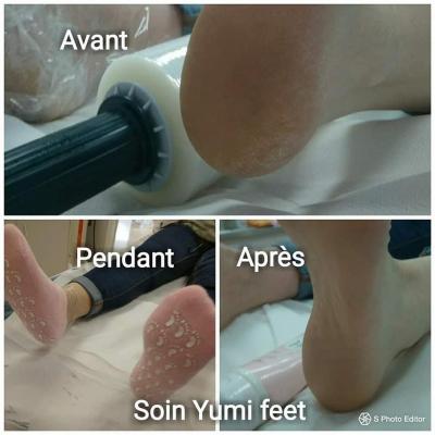 Yumi feet avant apres