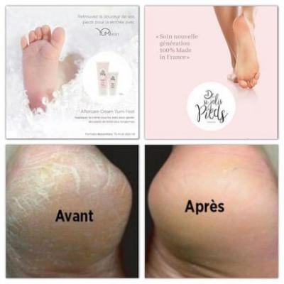 Yumifeet before after
